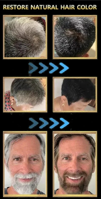 YH03 White Hair Killer White To Black HairAnti-grey Hair Essence Serum Treatment Restore Natural Hair Color and Restore Healthy